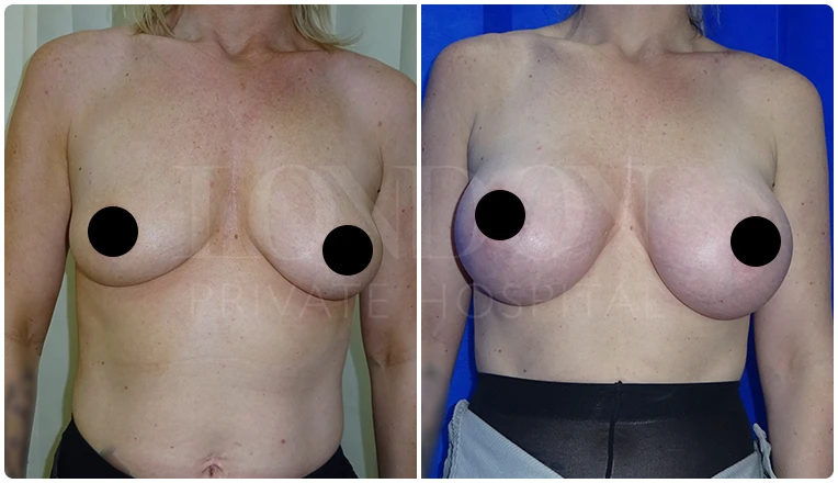 breast enlargement before and after patient-9