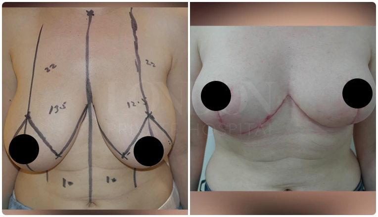breast reduction before and after patient - 1-v1