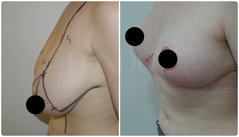 breast reduction before and after patient - 1-v2