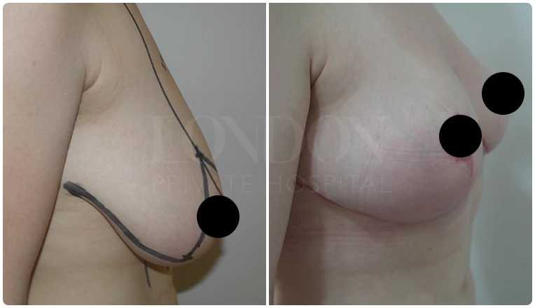 breast reduction before and after patient - 1