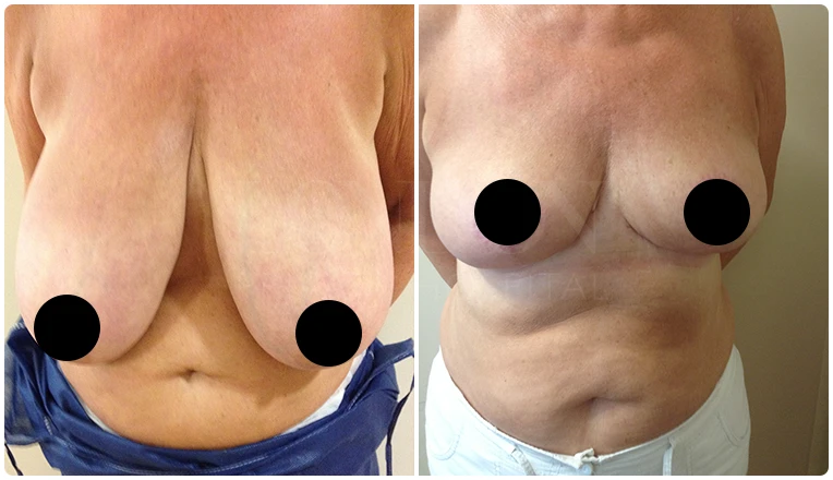 breast reduction before and after patient - 2