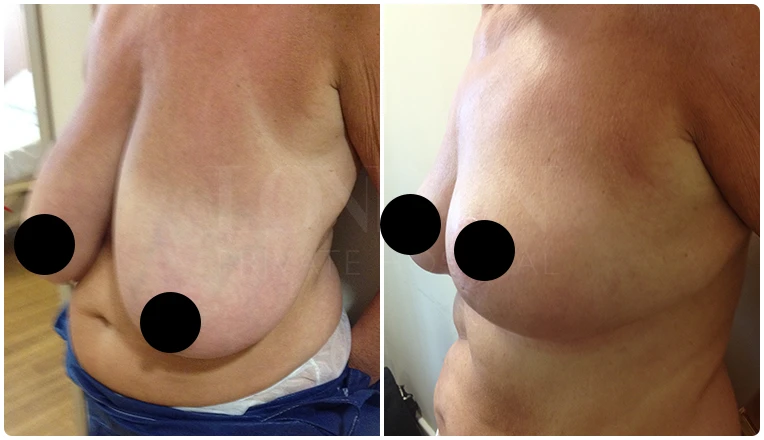 breast reduction surgery before and after patient - 2-v1