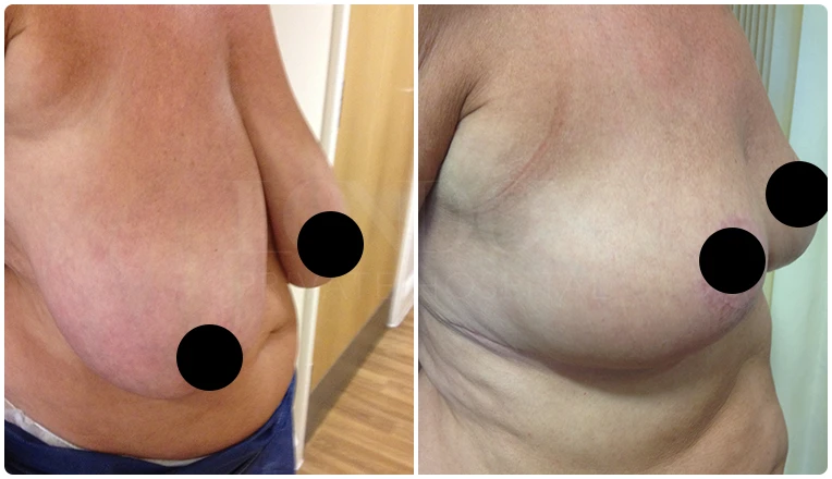 breast reduction surgery before and after patient - 2-v2