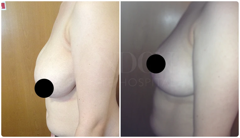 breast reduction surgery before and after patient - 3-v1