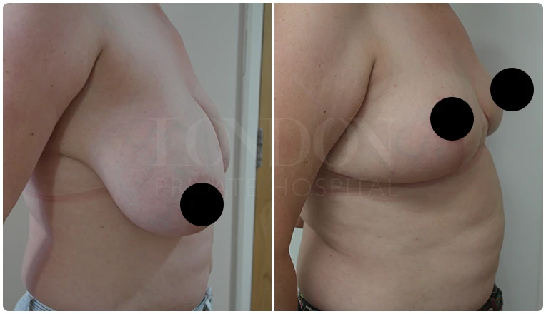 breast reduction surgery before and after patient - 4-v1