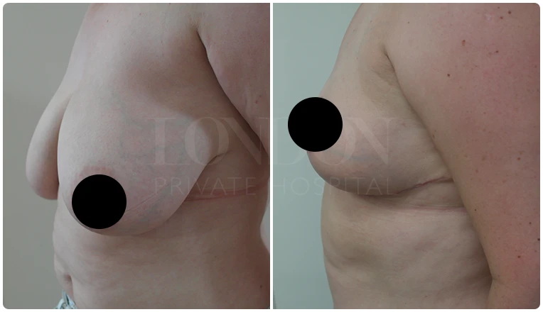 breast reduction surgery before and after patient - 4-v2
