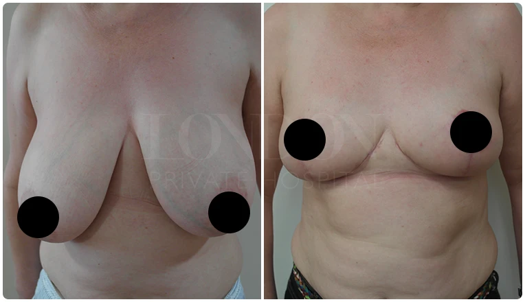 breast reduction surgery before and after patient - 4