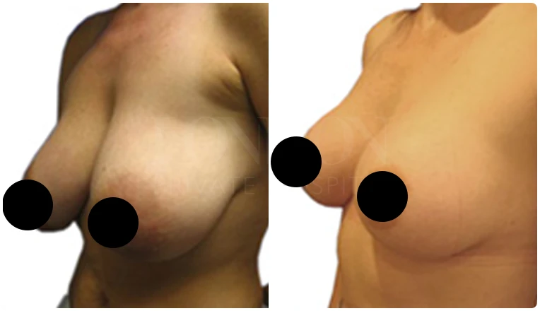 breast reduction surgery before and after patient - 5-v1