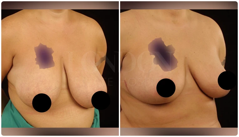 breast reduction surgery before and after patient - 5-v2