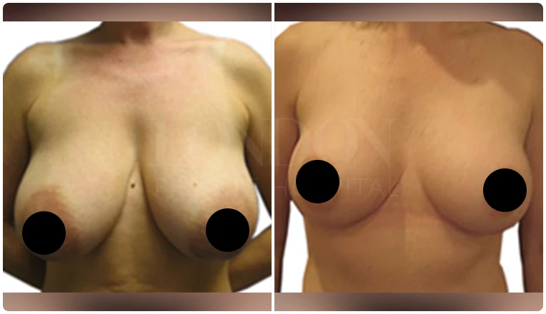 breast reduction surgery before and after patient - 5