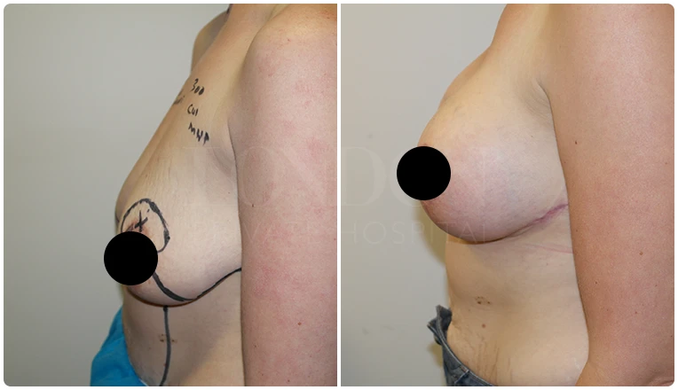 breast uplift before and after patient - 1-v1
