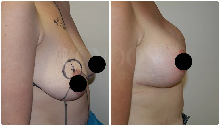 breast uplift before and after patient - 1-v2