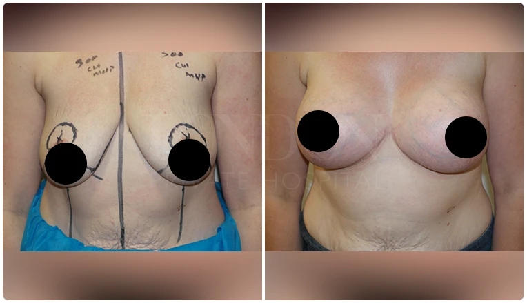 breast uplift before and after patient - 1