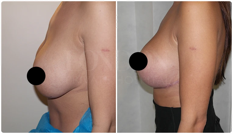 breast uplift before and after patient - 2-v1