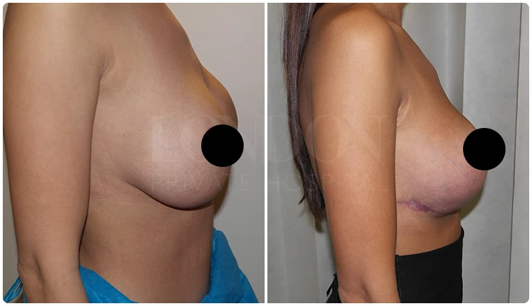 breast uplift before and after patient - 2-v2