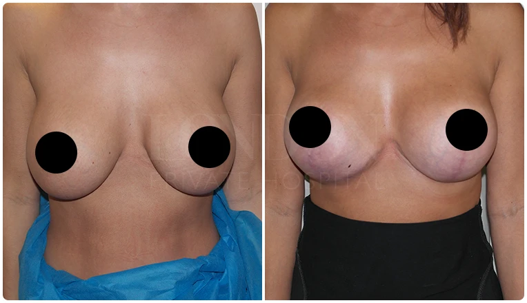 breast uplift before and after patient - 2