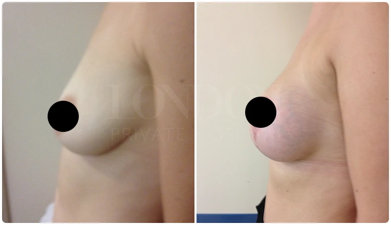 breast uplift before and after patient - 3-v1