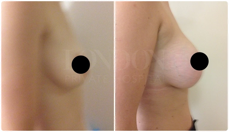breast uplift before and after patient - 3-v2