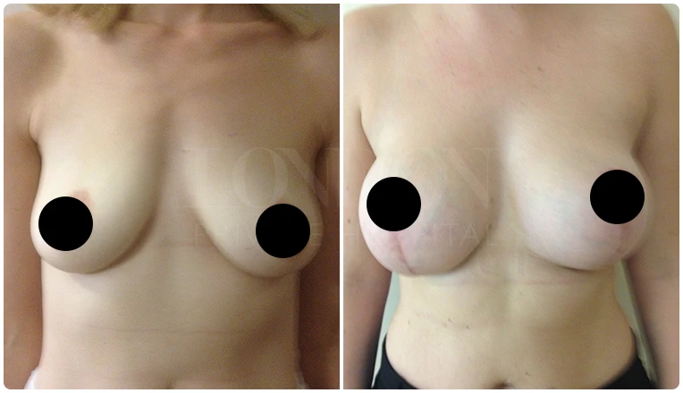 breast uplift before and after patient - 3