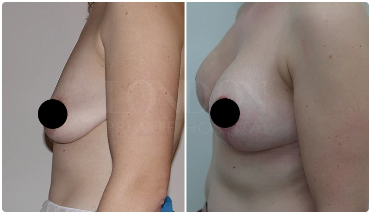 breast uplift before and after patient - 4-v1
