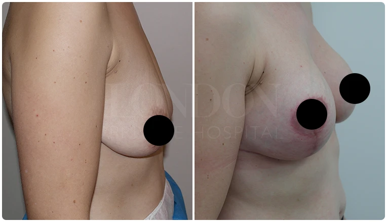 breast uplift before and after patient - 4-v2