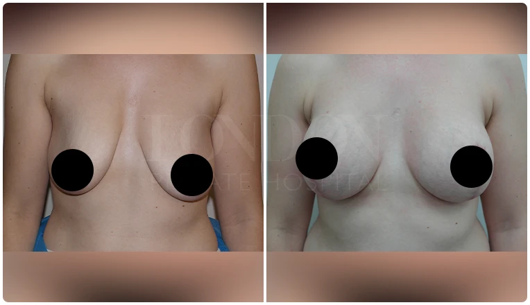 breast uplift before and after patient - 4