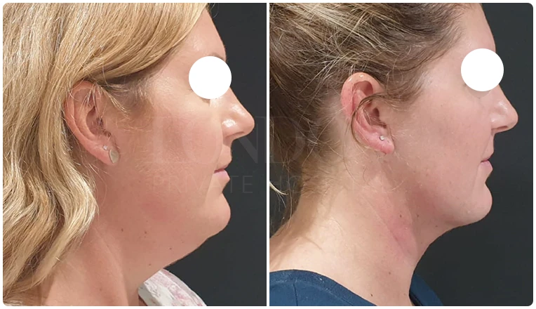 facial vaser liposuction before and after patient -1-v1