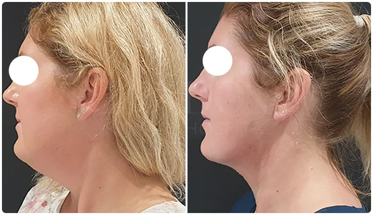 facial vaser liposuction before and after patient -1-v2
