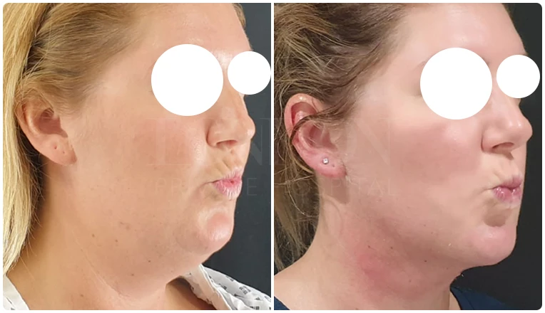 facial vaser liposuction before and after patient -1
