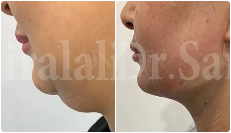 facial vaser liposuction before and after patient -10