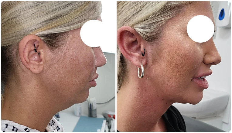 facial vaser liposuction before and after patient -2-v1