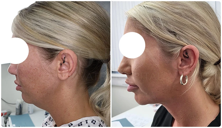 facial vaser liposuction before and after patient -2-v2