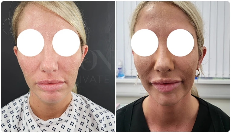 facial vaser liposuction before and after patient -2
