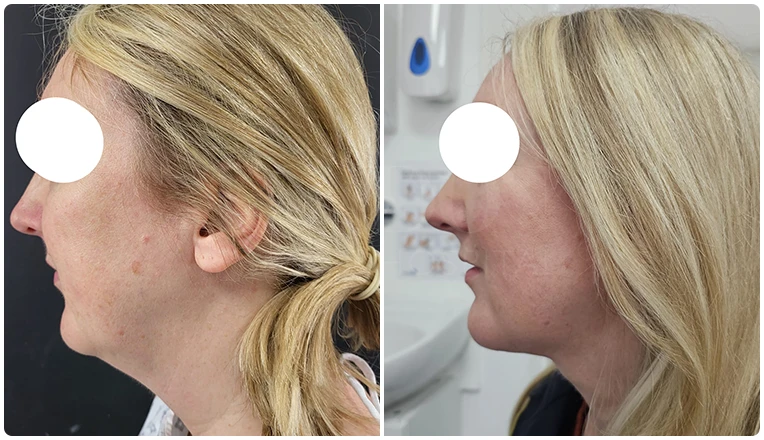 facial vaser liposuction before and after patient -3-v1