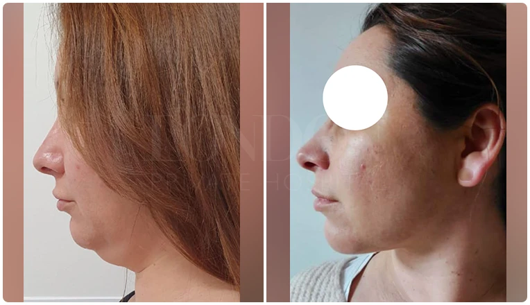 facial vaser liposuction before and after patient -4-v1