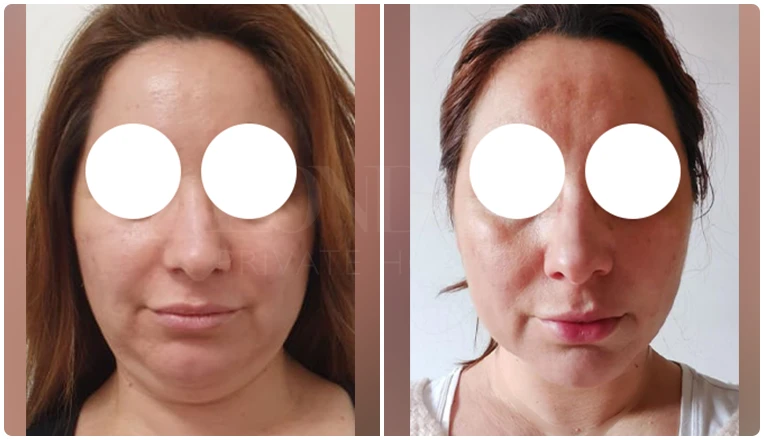 facial vaser liposuction before and after patient -4