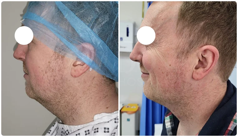 facial vaser liposuction before and after patient -5-v1