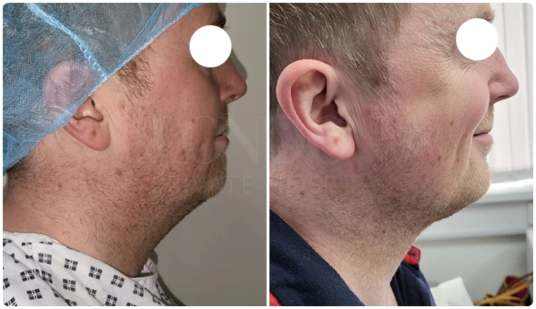 facial vaser liposuction before and after patient -5