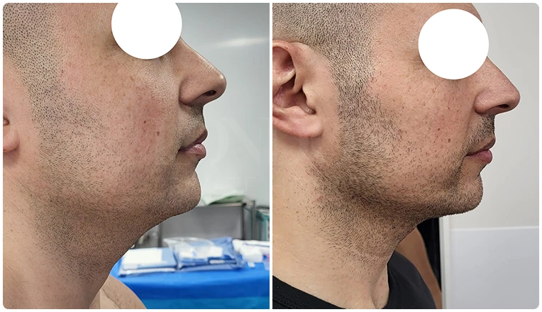 facial vaser liposuction before and after patient -6-v1