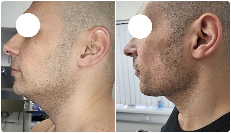 facial vaser liposuction before and after patient -6