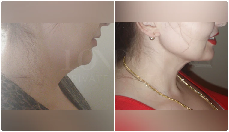 facial vaser liposuction before and after patient -7