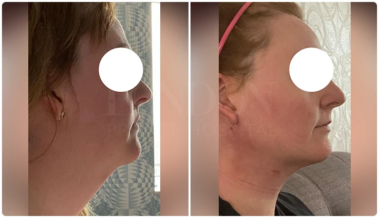 facial vaser liposuction before and after patient -8
