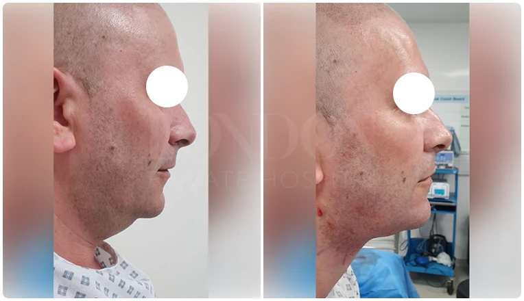 facial vaser liposuction before and after patient -9