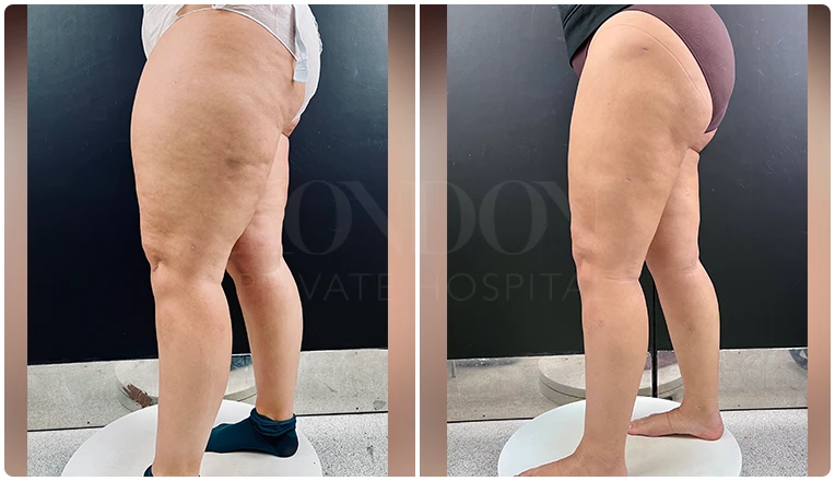 lipedema surgery before and after patient -1-v1