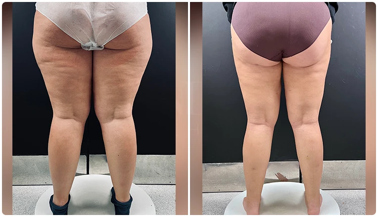 lipedema surgery before and after patient -1-v3