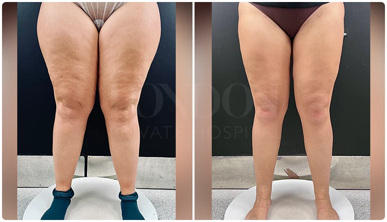 lipedema surgery before and after patient -1