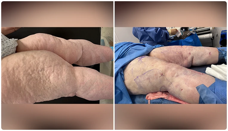 lipedema surgery before and after patient -2