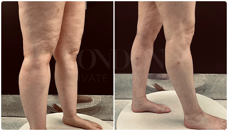 lipedema surgery before and after patient -3-v1