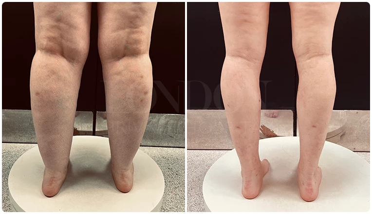 lipedema surgery before and after patient -3-v2