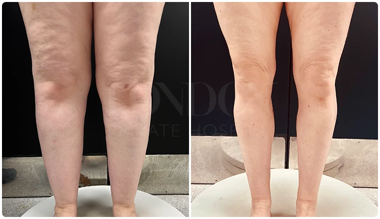 lipedema surgery before and after patient -3
